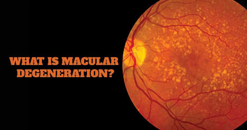 Macular Degeneration, Causes Symptoms and its 2 Types | Marham