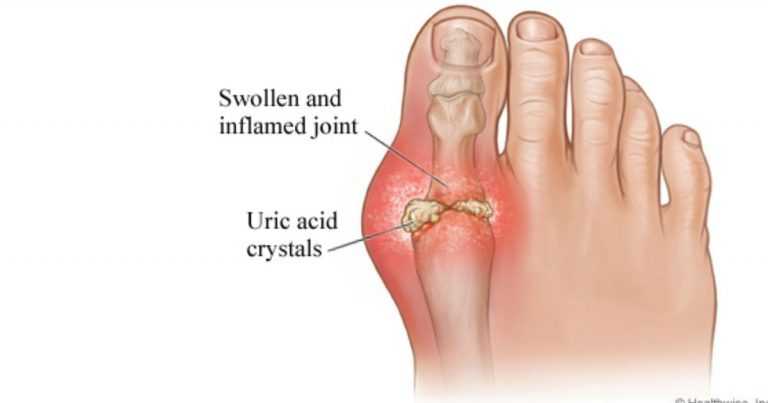 4 Signs Of Excess Uric Acid In The Body Marham 1569