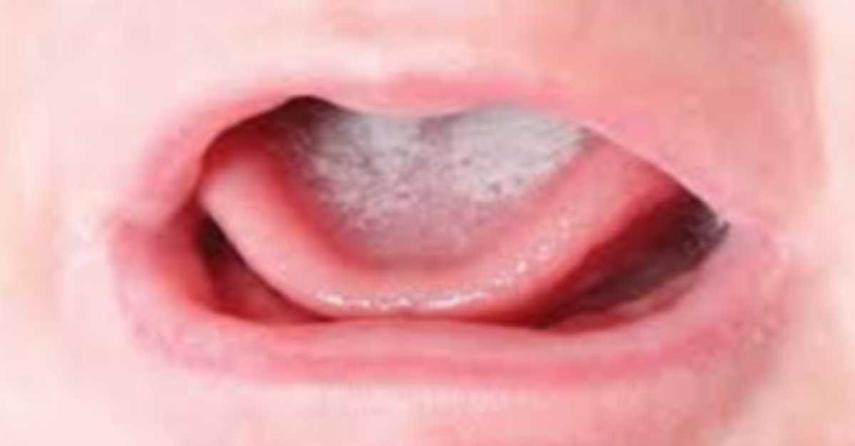 Baby Yeast Infection In Mouth