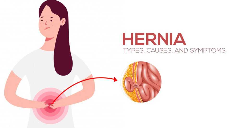 Types, Causes, and Symptoms of Hernia