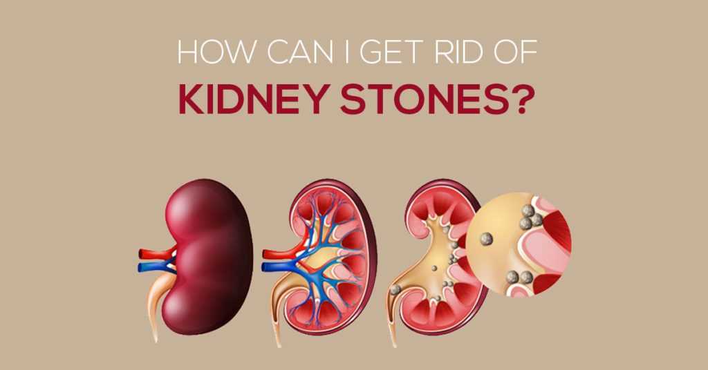 how-to-get-rid-of-kidney-stones-know-6-easy-tips-marham