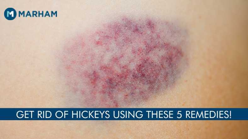 How to Get Rid of Hickeys Overnight? 5 Fast Solutions!
